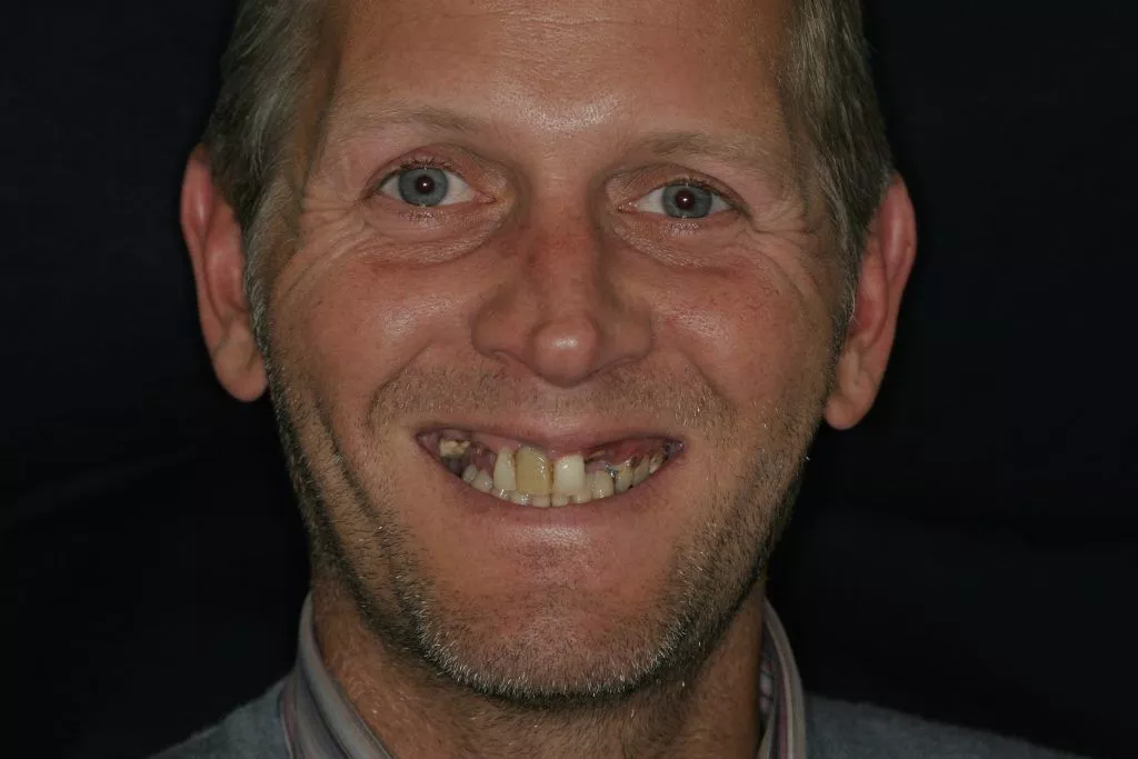 Jonathan's Before and After, TDC Implant Centres.