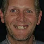 Jonathan's Before and After, TDC Implant Centres.