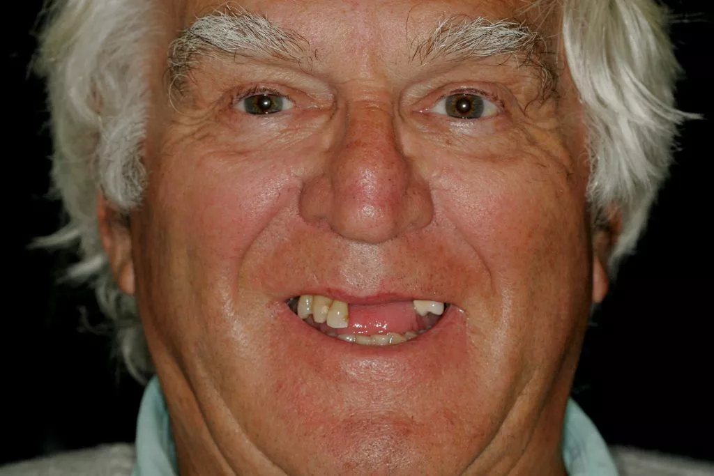 Geoffrey's Story, TDC Implant Centres