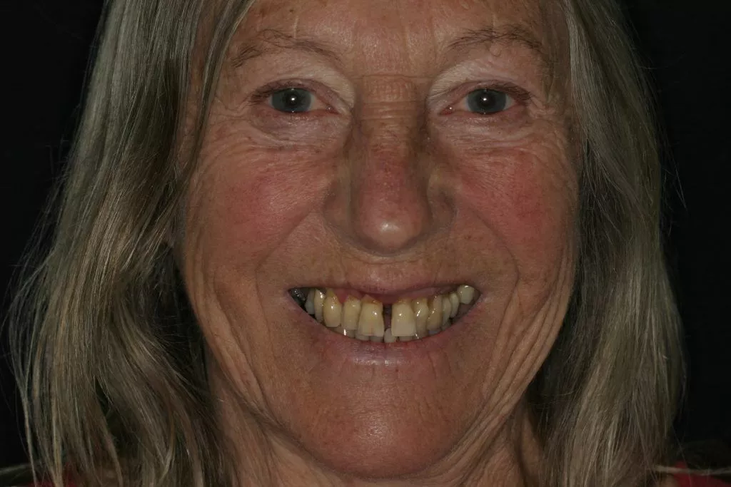 Pamela's Story, TDC Implant Centres