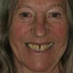 Pamela's Story, TDC Implant Centres