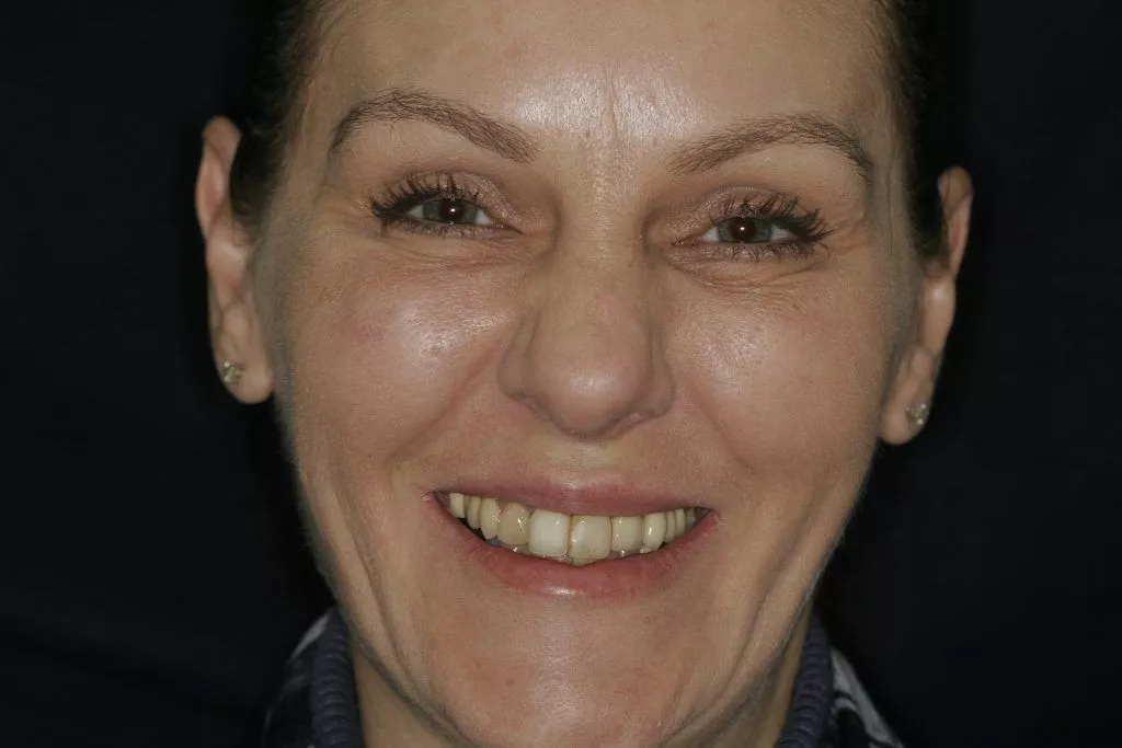 Mary's Story, TDC Implant Centres