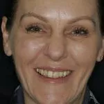 Mary's Story, TDC Implant Centres