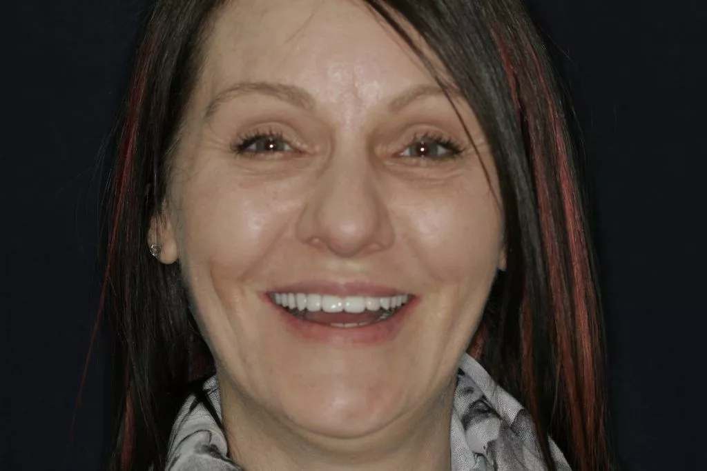 Mary's Story, TDC Implant Centres