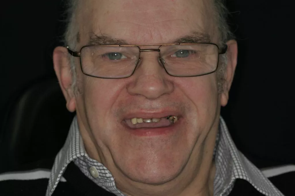 Henry's Story, TDC Implant Centres