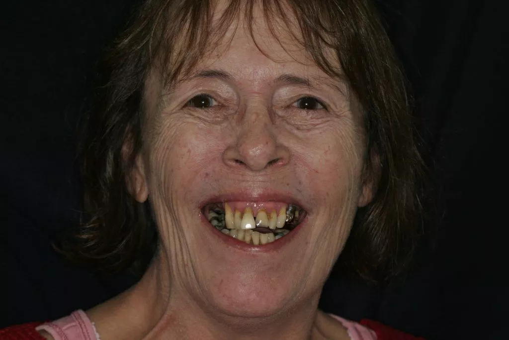 Sharon's Story, TDC Implant Centres