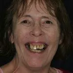 Sharon's Story, TDC Implant Centres
