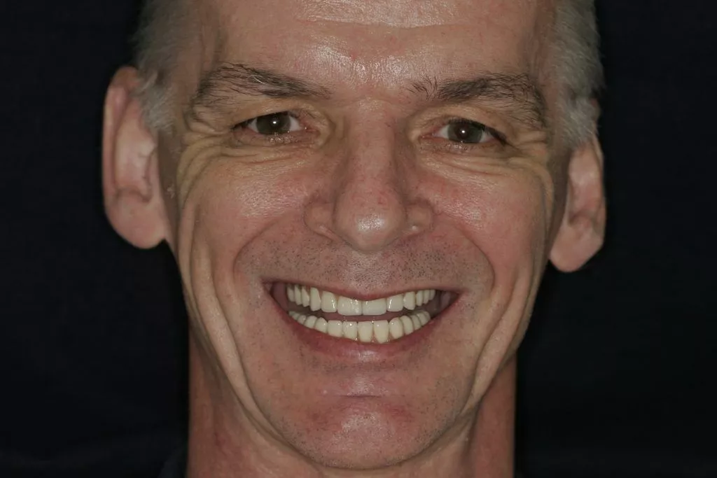 Gordon's Story, TDC Implant Centres