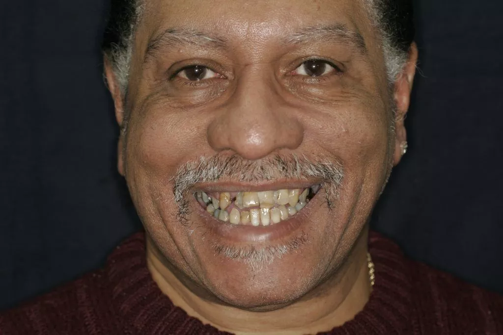 Keith's Story, TDC Implant Centres