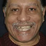 Keith's Story, TDC Implant Centres