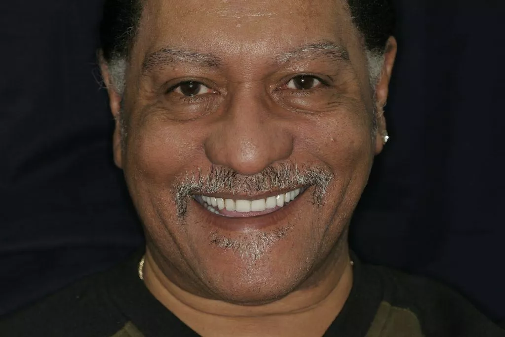 Keith's Story, TDC Implant Centres
