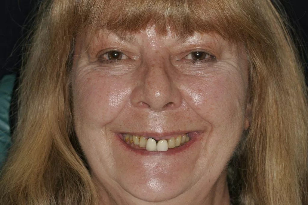 Jaquelin's Story, TDC Implant Centres