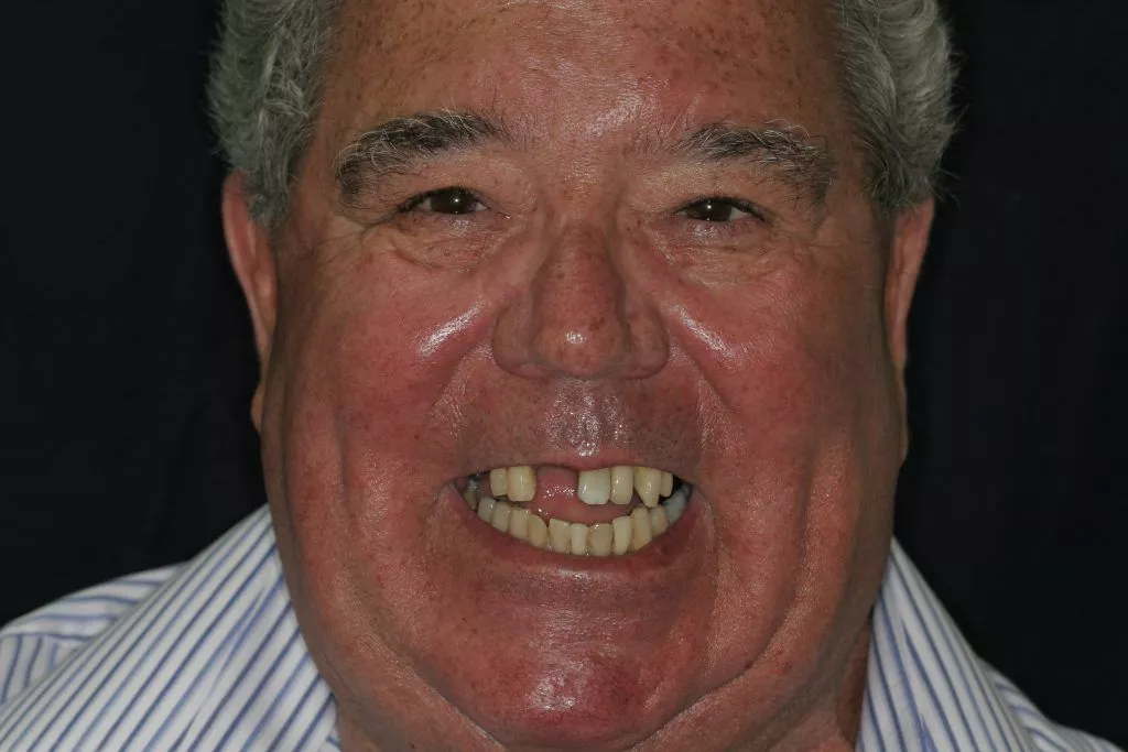 Tony's Story, TDC Implant Centres