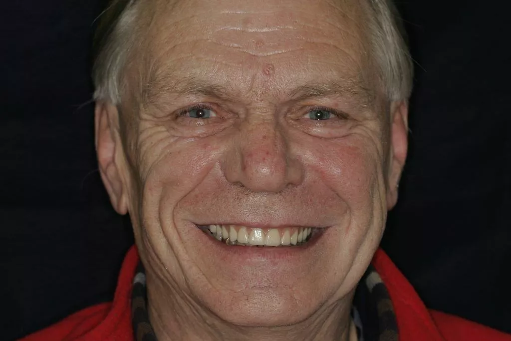 Peter's Story, TDC Implant Centres