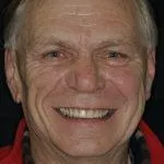 Peter's Story, TDC Implant Centres