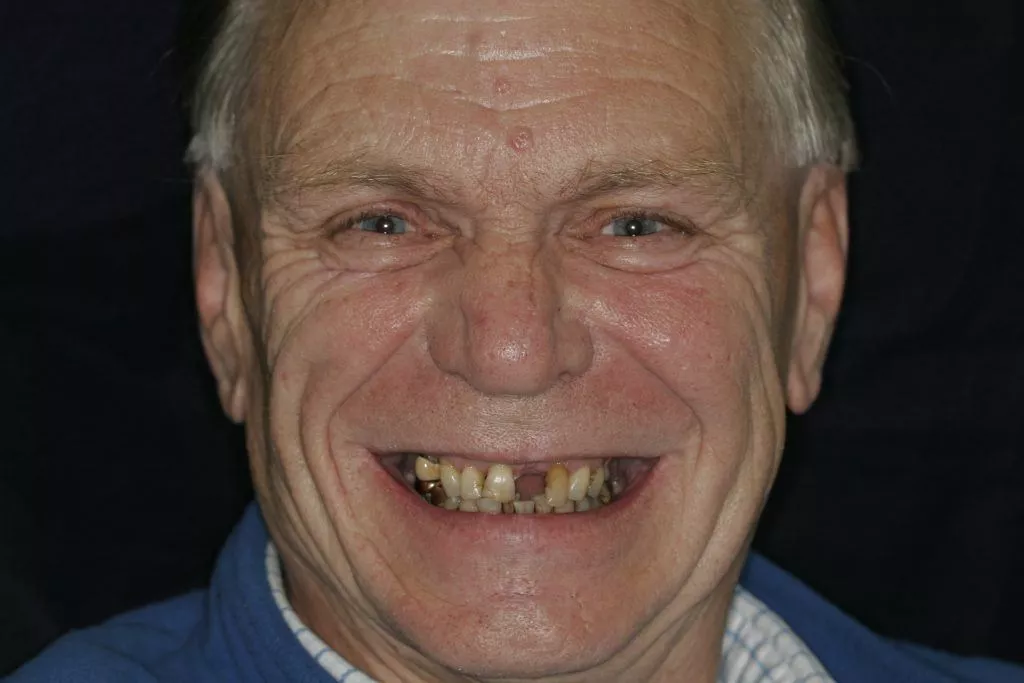 Peter's Story, TDC Implant Centres