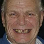 Peter's Story, TDC Implant Centres