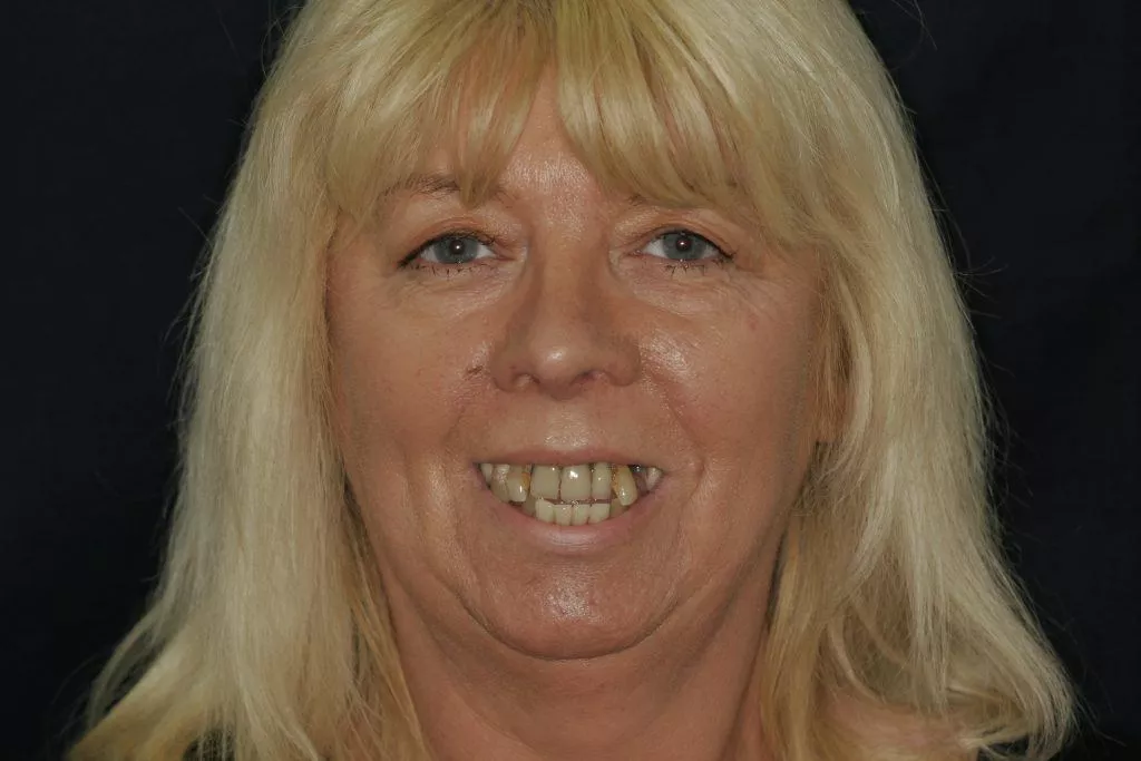 Sharon's Story, TDC Implant Centres