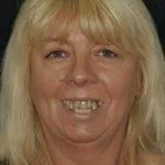 Sharon's Story, TDC Implant Centres