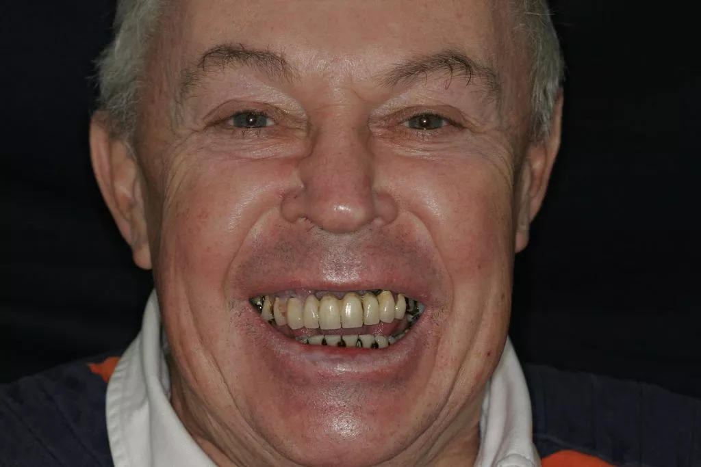 Dennis's Story, TDC Implant Centres