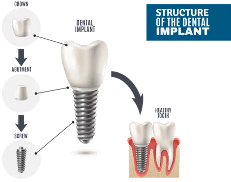 structure-of-the-dental-implant