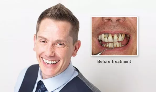 “I walked in one morning and walked out later that afternoon with a full set of teeth – top and bottom – so it can be done in a day!” Robert, TDC patient