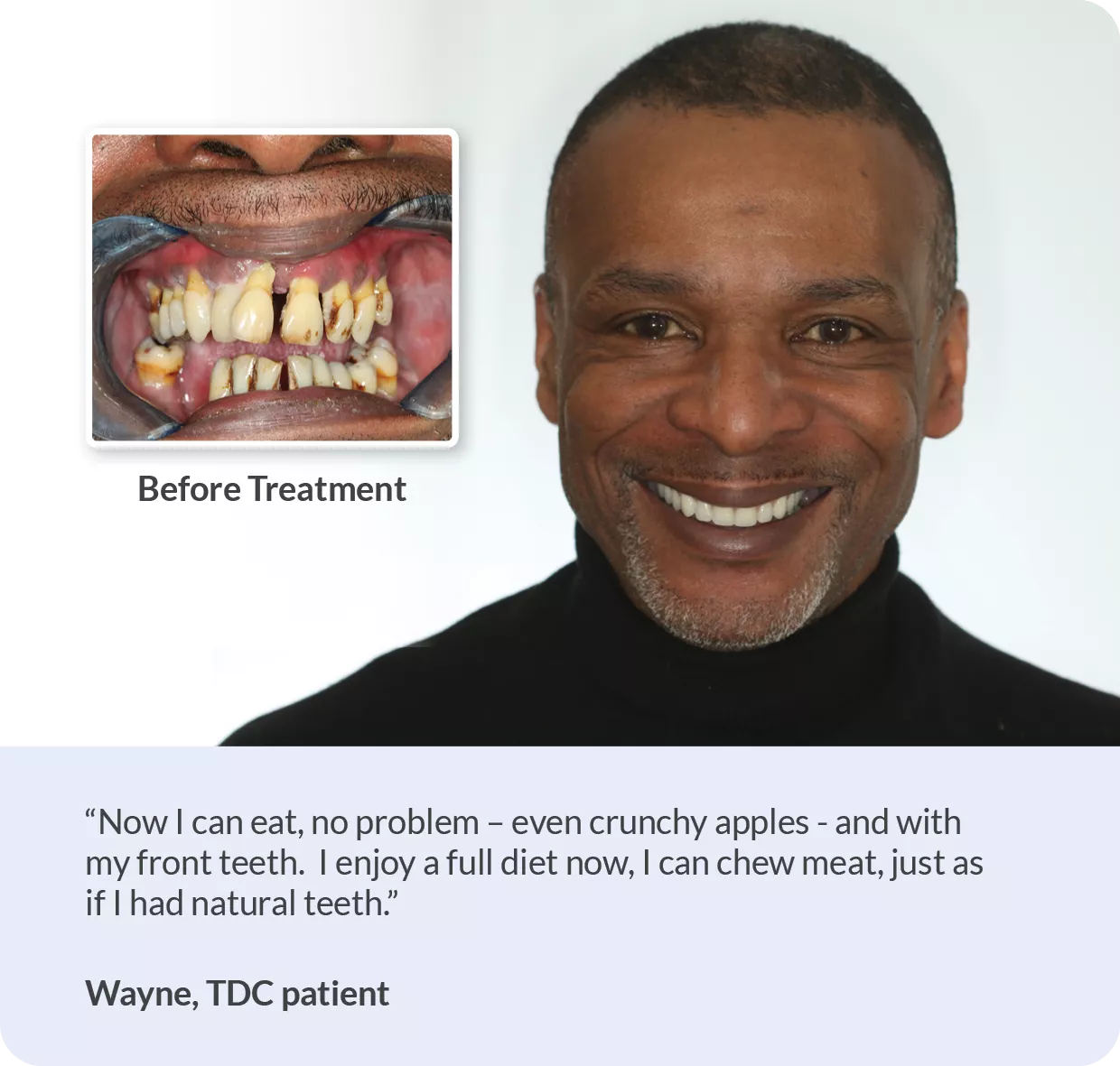 What can I eat after dental implant surgery? TDC Dental Implants Centre